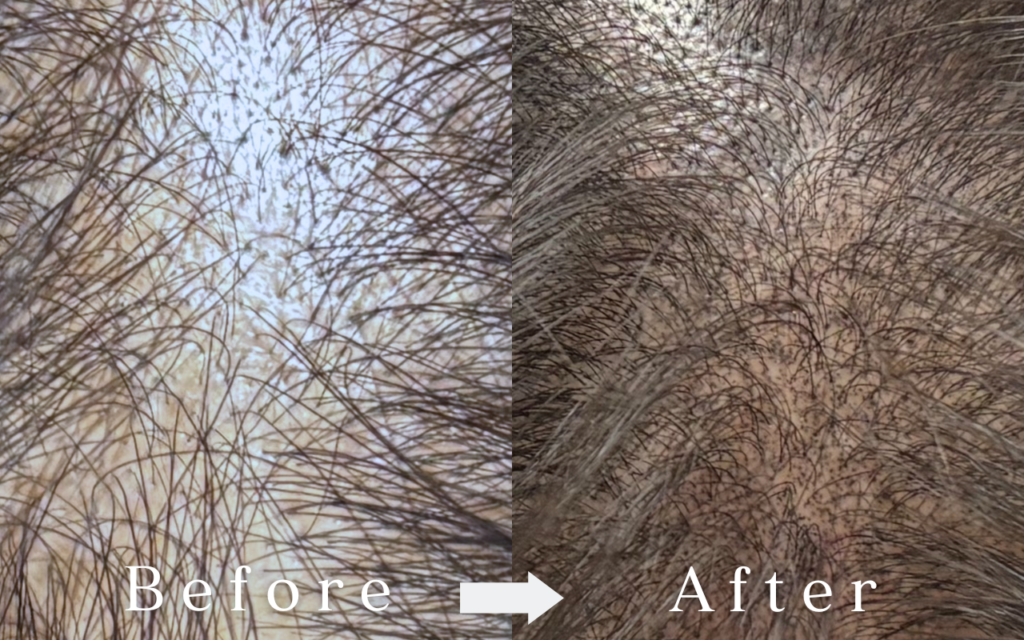 東京麻布十番美容室　スカルプインク　薄毛　エイジング毛　頭皮アートメイク　