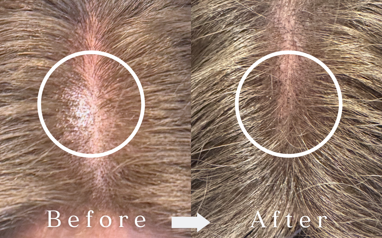 スカルプインク ビフォーアフター｜女性・分け目のシャドウ表現