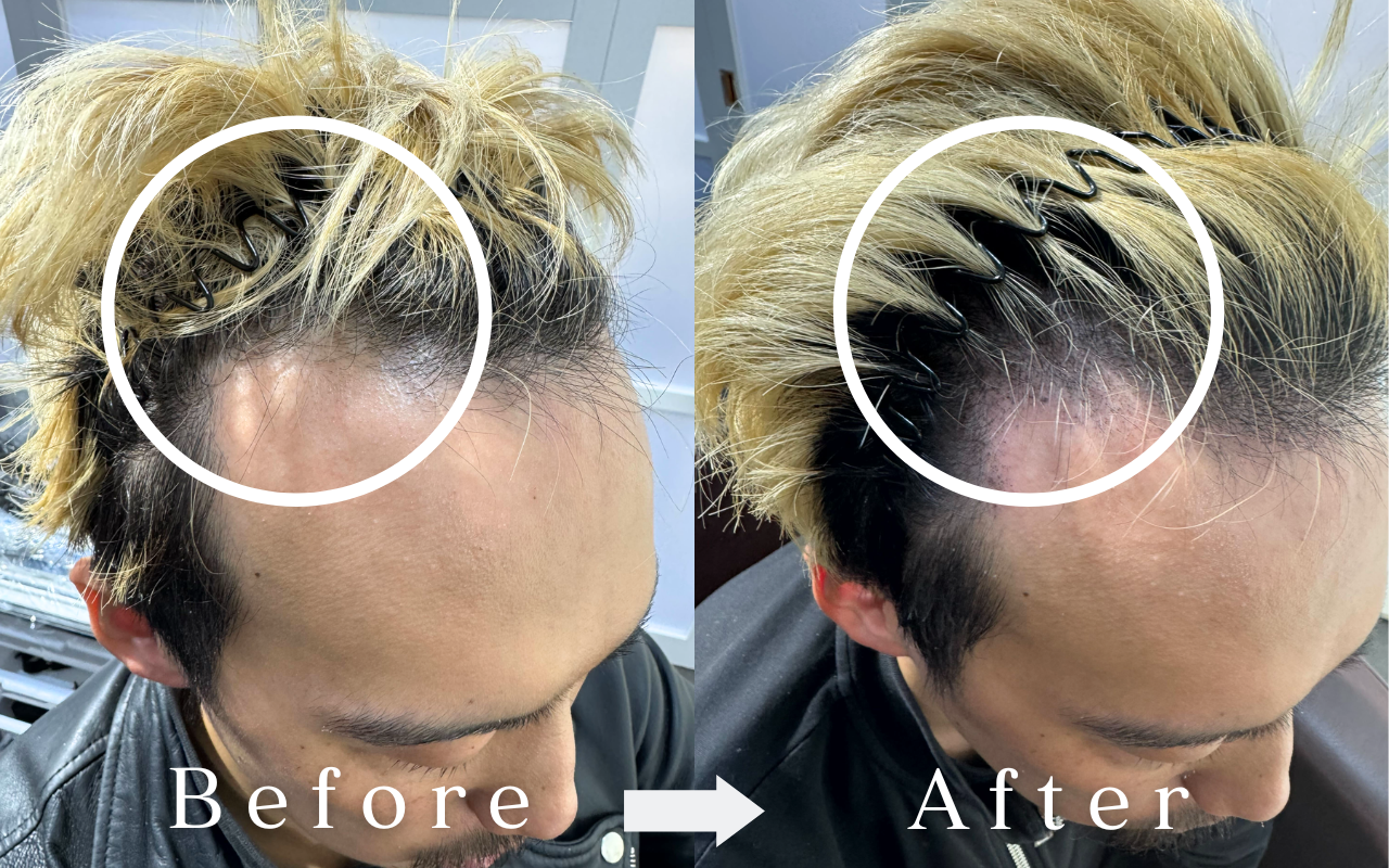 スカルプインク 薄毛 頭皮アートメイク ビフォーアフター 女性分け目