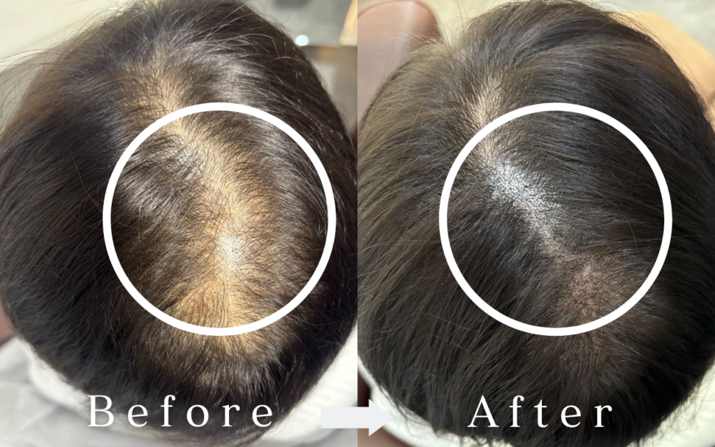 東京麻布十番美容室　スカルプインク　薄毛　エイジング毛　頭皮アートメイク　