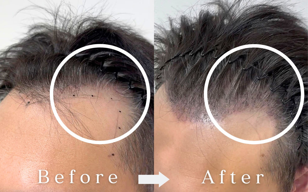 スカルプインク ビフォーアフター｜男性・生え際のシャドウ表現