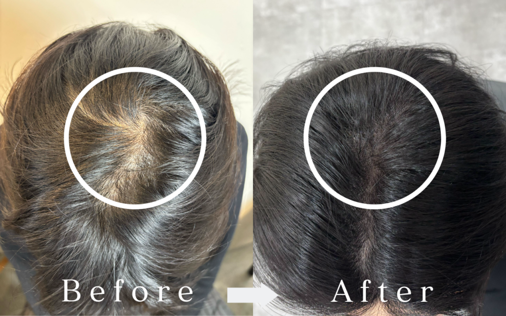 東京麻布十番美容室　スカルプインク　薄毛　エイジング毛　頭皮アートメイク　